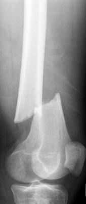 fractured femur